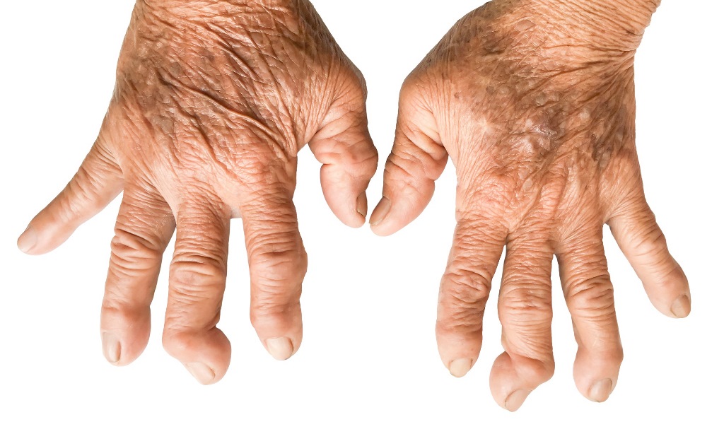 Seberapa Jauh Anda Tahu Tentang Rheumatoid Arthritis Ra Atau Rematik